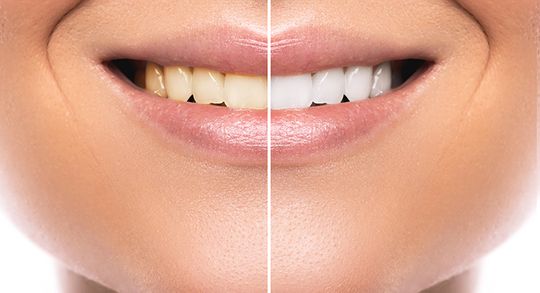 Side by side comparison of teeth before and after teeth whitening by Dr. James A. Vette, DDS in Germantown, MD