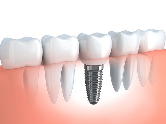 Graphic displaying the types of dental implant work offered by Dr. James A. Vette, DDS in Germantown, MD